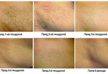 Photo of Что такое студия лазерной эпиляции и как она работает