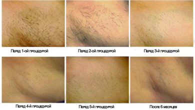 Photo of Что такое студия лазерной эпиляции и как она работает